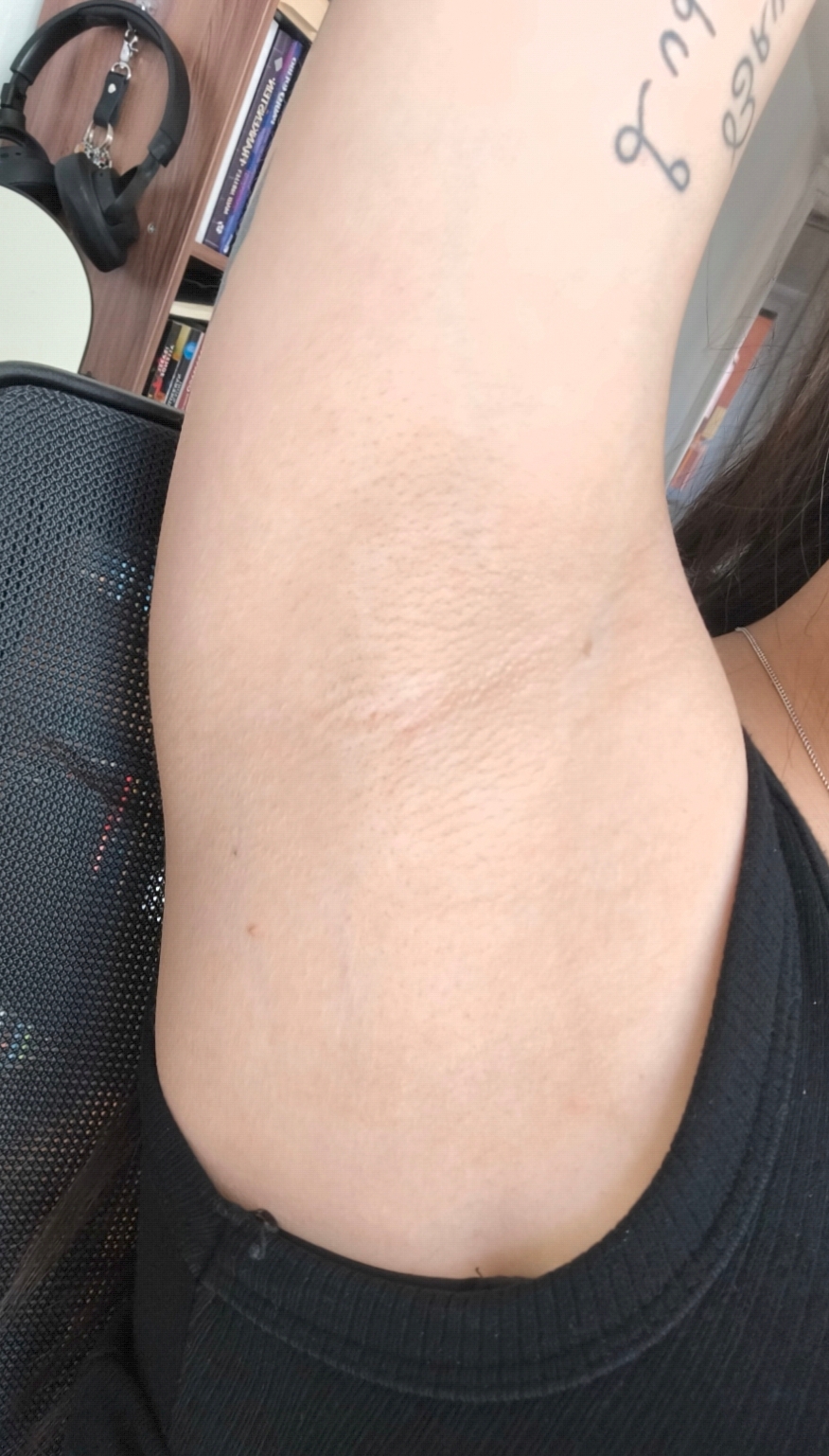 prima e dopo depilazione laser depilazione laser ascelle ascelle milano depilazione laser a milano foto 1 anno - 705