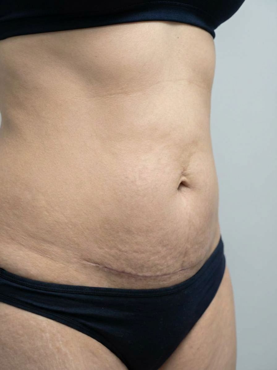 prima e dopo addominoplastica addominoplastica estesa addome borgosesia addominoplastica estesa per migliorare addome foto dopo - 437