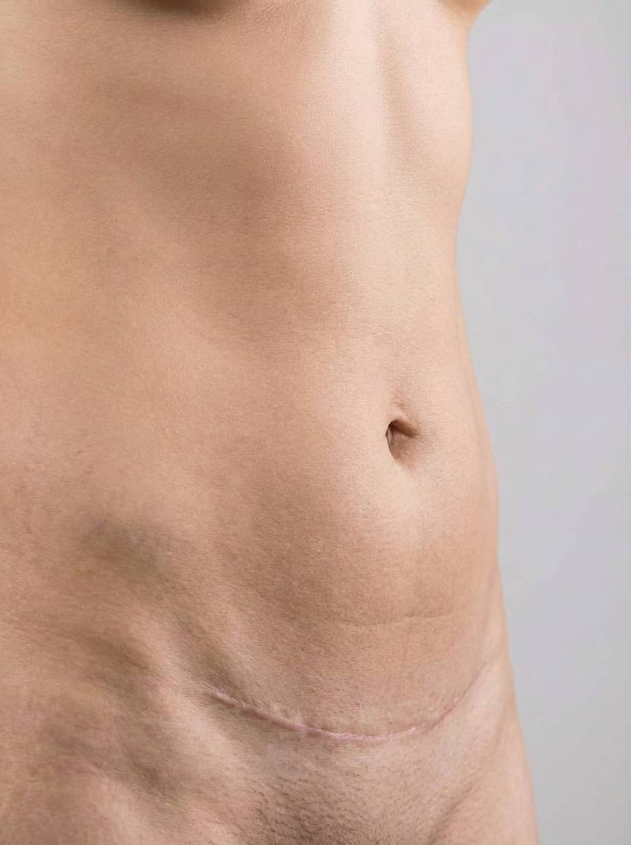 prima e dopo addominoplastica addominoplastica post gravidanza addome fossano addominoplastica post gravidanza per migliorare addome foto dopo - 446