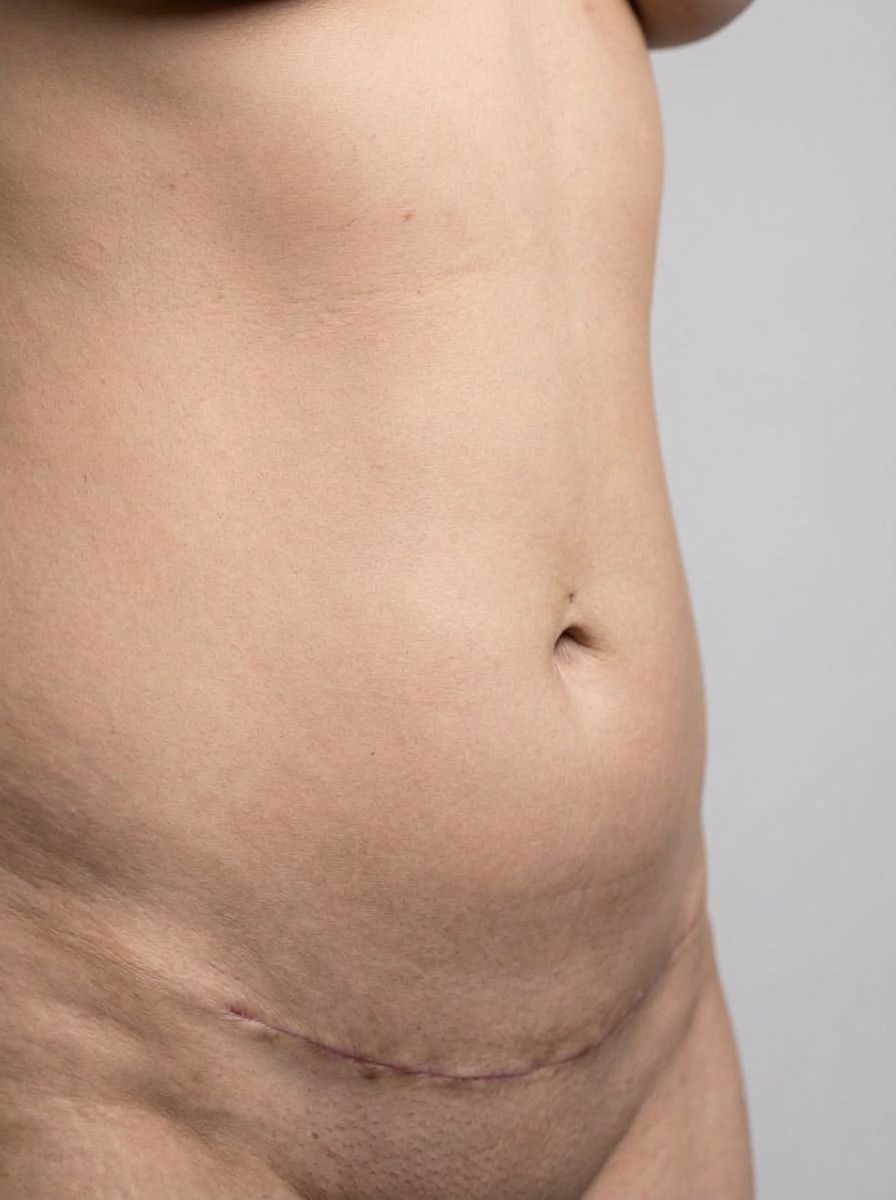 prima e dopo addominoplastica addominoplastica circonferenziale addome gattinara addominoplastica circonferenziale per migliorare addome foto dopo - 438