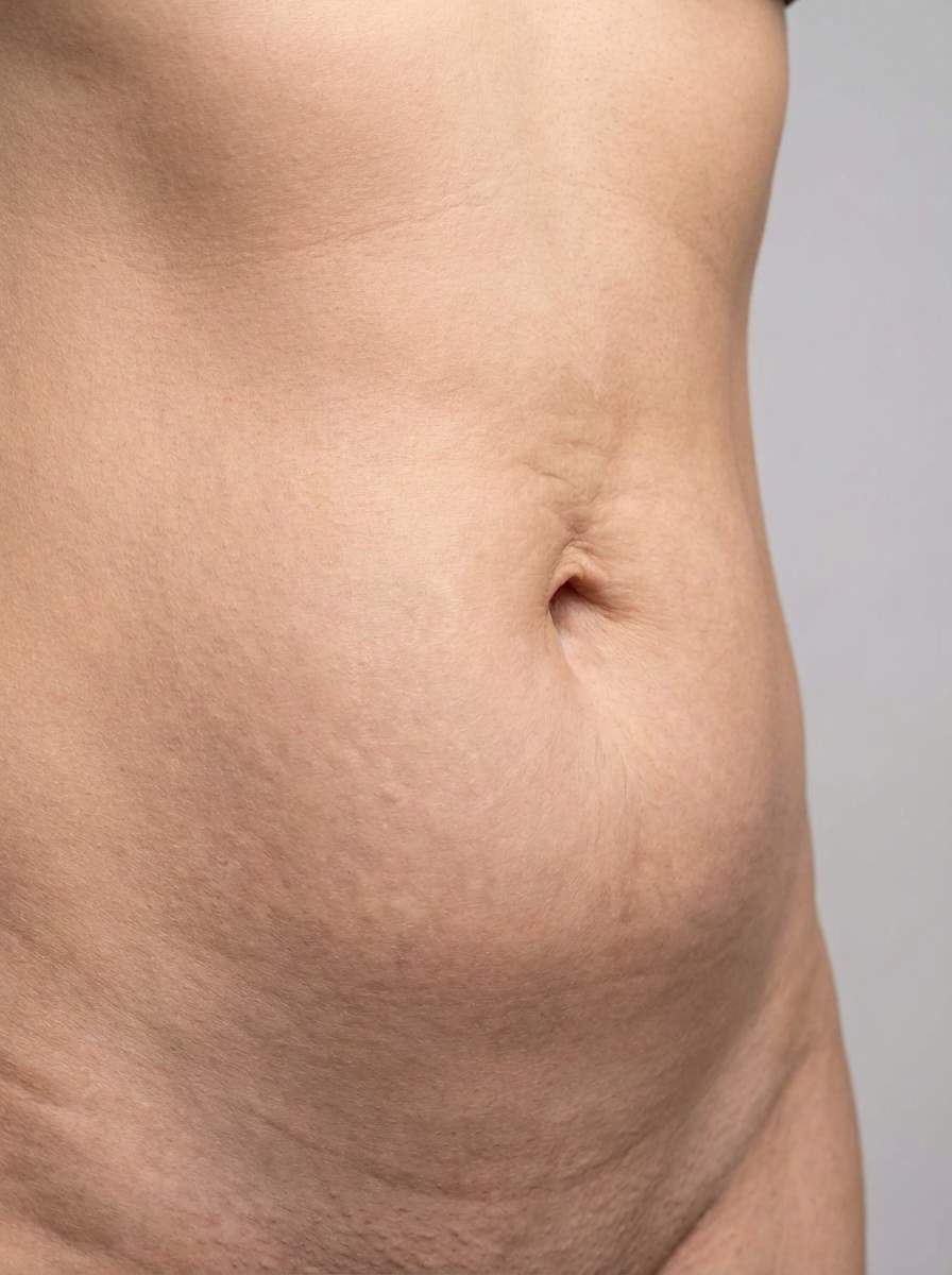 prima e dopo addominoplastica addominoplastica mini addome gravellona toce addominoplastica mini per migliorare addome foto dopo - 435