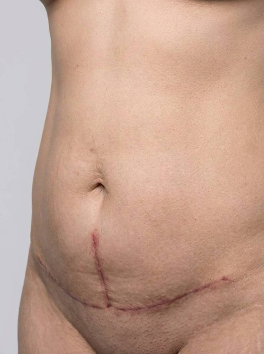 prima e dopo addominoplastica addominoplastica t invertita addome santhià addominoplastica t invertita per migliorare addome foto dopo - 440