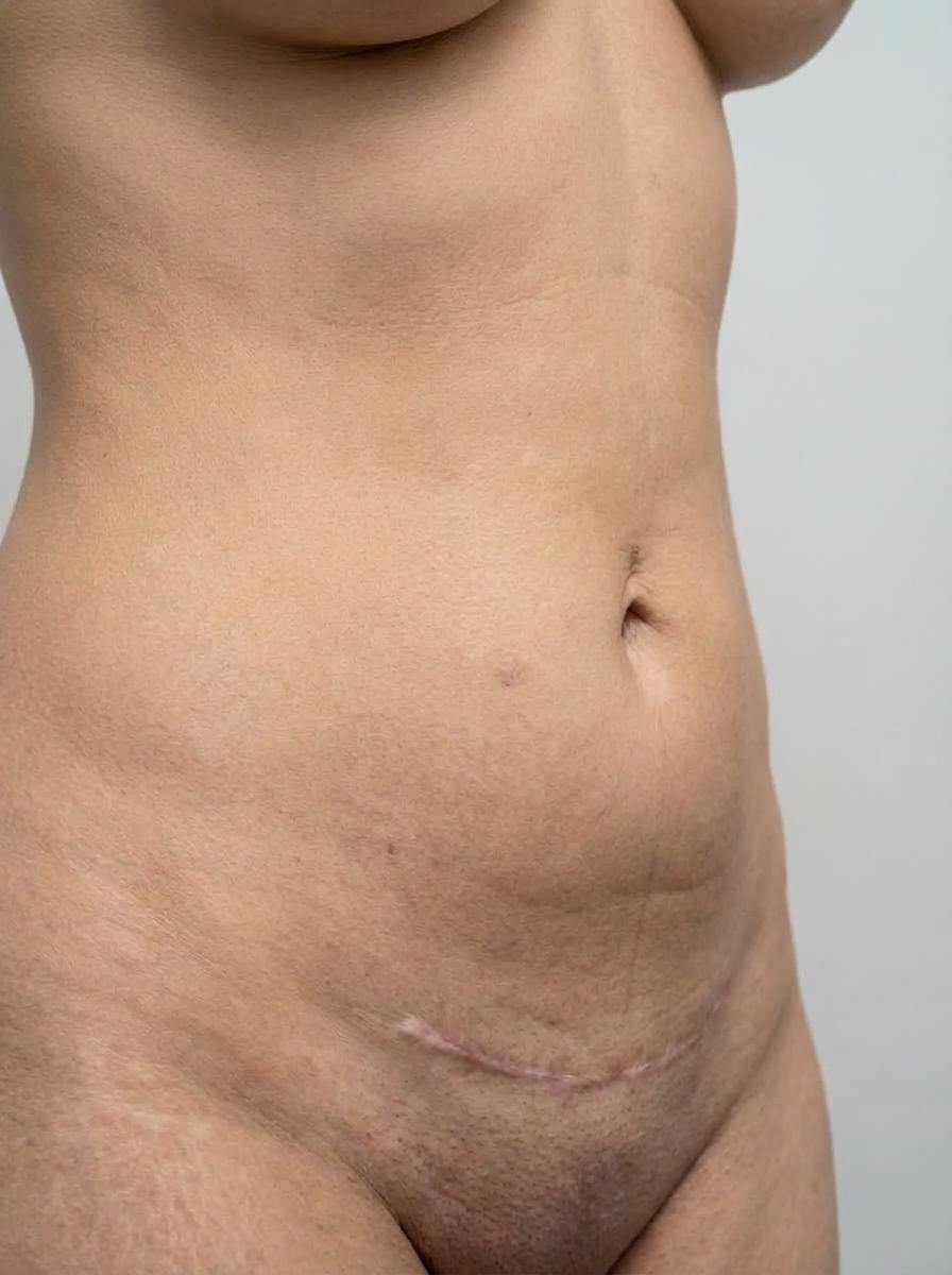 prima e dopo addominoplastica addominoplastica completa addome stresa addominoplastica completa per migliorare addome foto dopo - 436