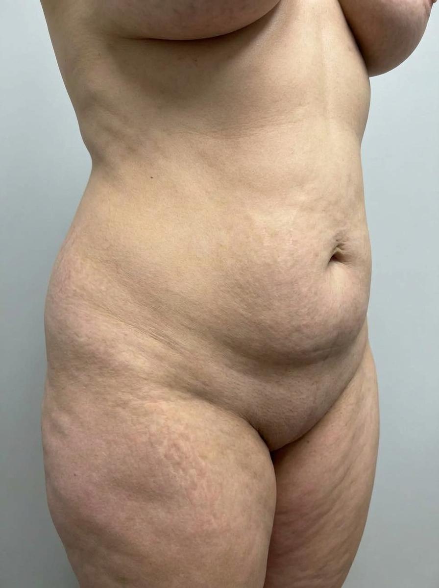 prima e dopo addominoplastica addominoplastica con liposuzione addome vigliano biellese addominoplastica con liposuzione per migliorare addome foto dopo - 443