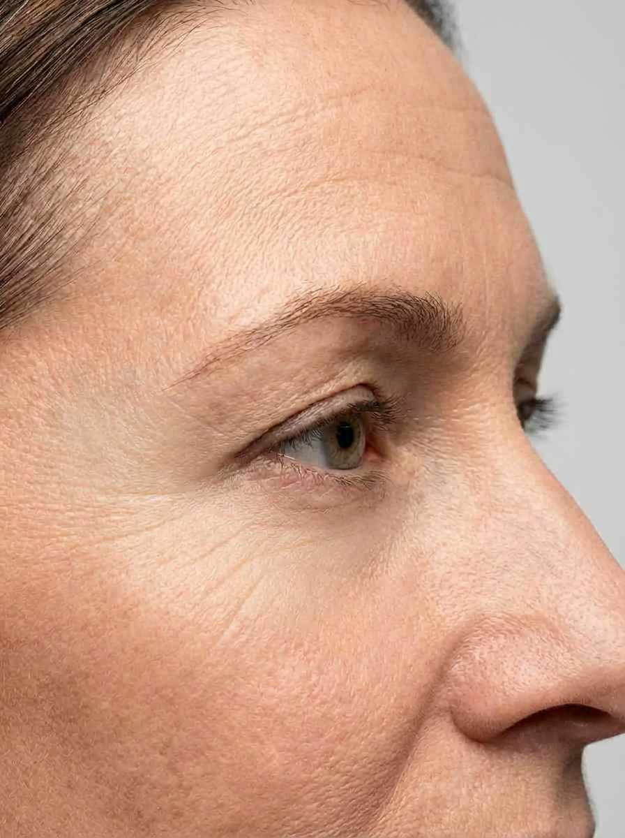 prima e dopo botox baby botox occhi seregno baby botox per migliorare occhi foto dopo - 175