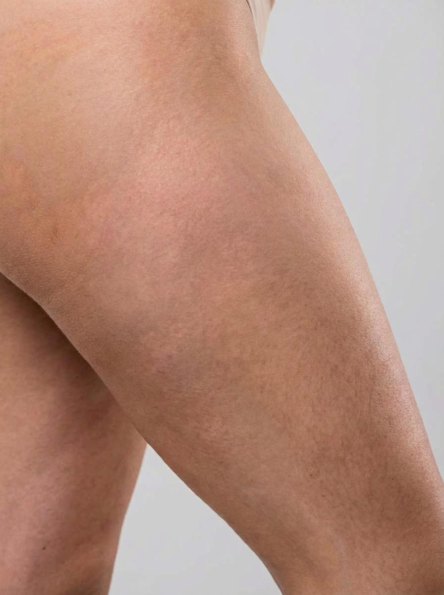 prima e dopo carbossiterapia carbossiterapia smagliature gambe volla carbossiterapia smagliature per migliorare gambe foto dopo - 495