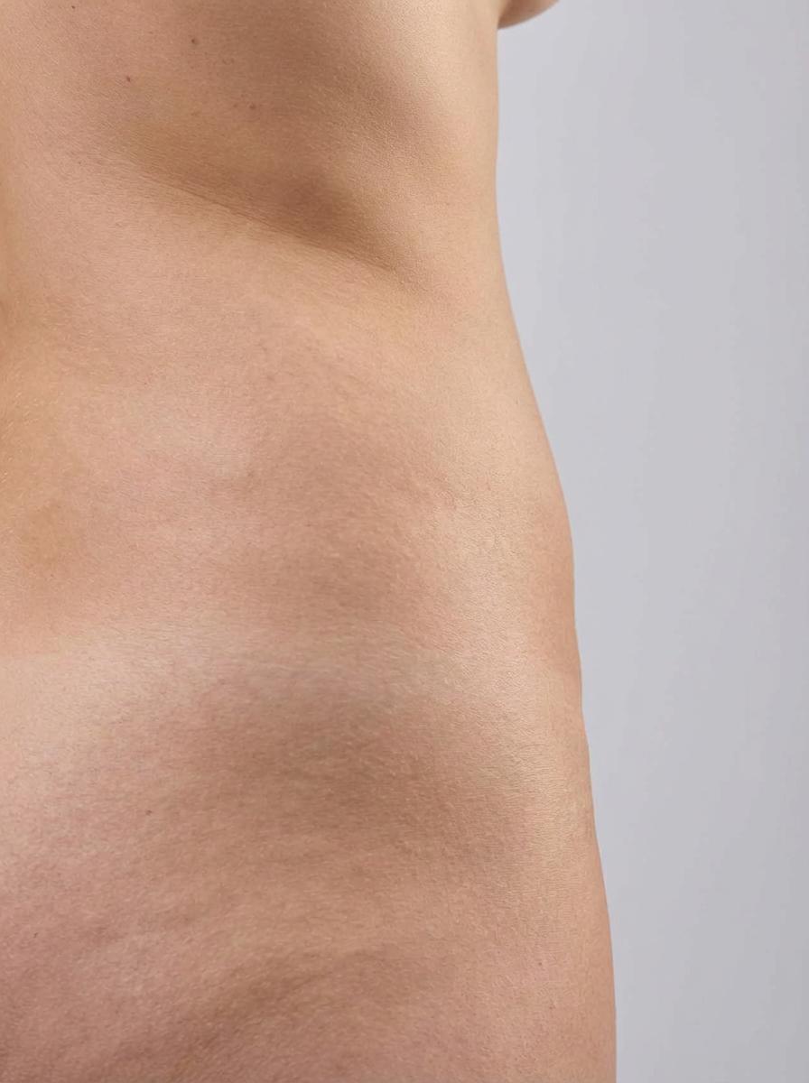 prima e dopo cavitazione cavitazione ultrasonica fianchi san damiano d'asti cavitazione ultrasonica per migliorare fianchi foto dopo - 452