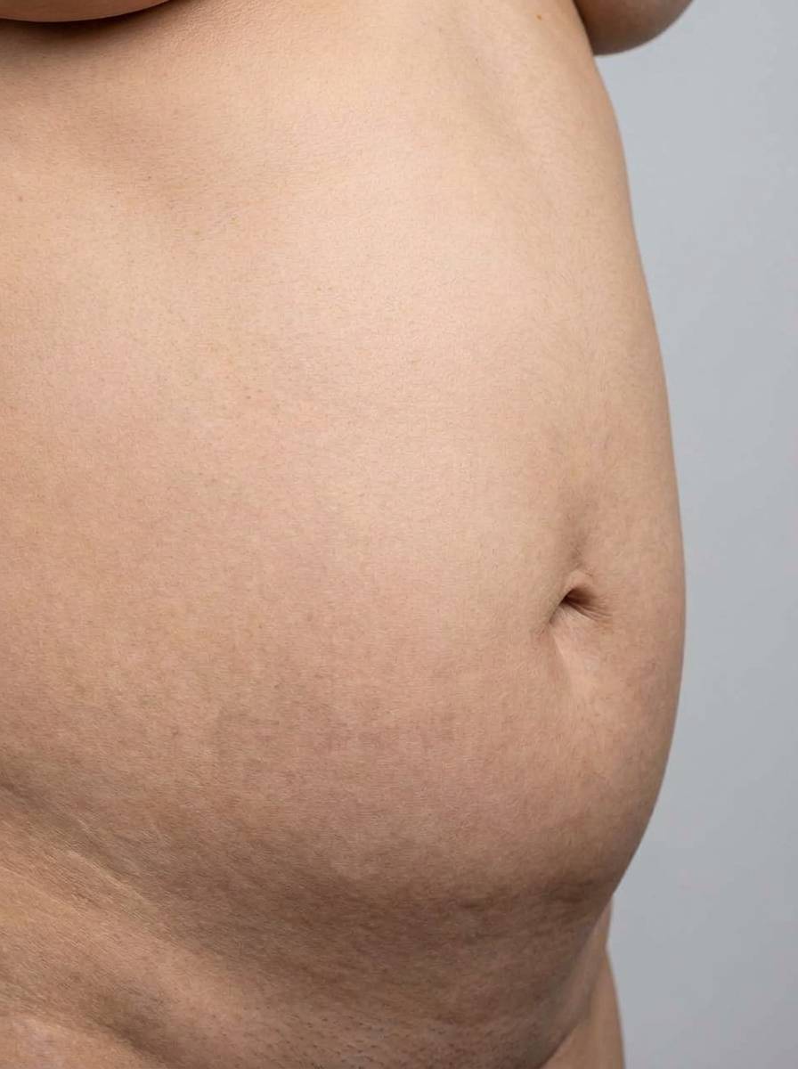 prima e dopo chirurgia bariatrica palloncino gastrico elipse addome asiago palloncino gastrico elipse per migliorare addome foto dopo - 693