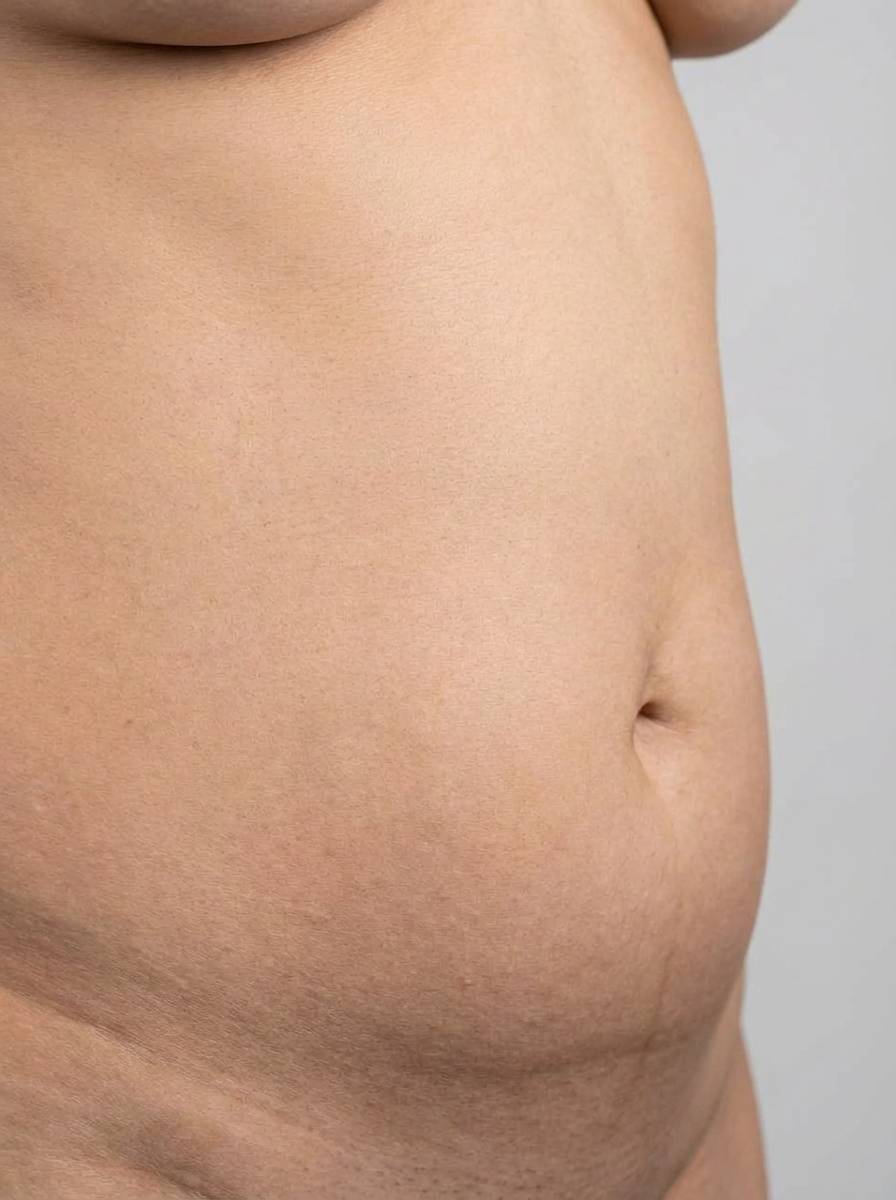 prima e dopo chirurgia bariatrica palloncino gastrico addome luserna palloncino gastrico per migliorare addome foto dopo - 692