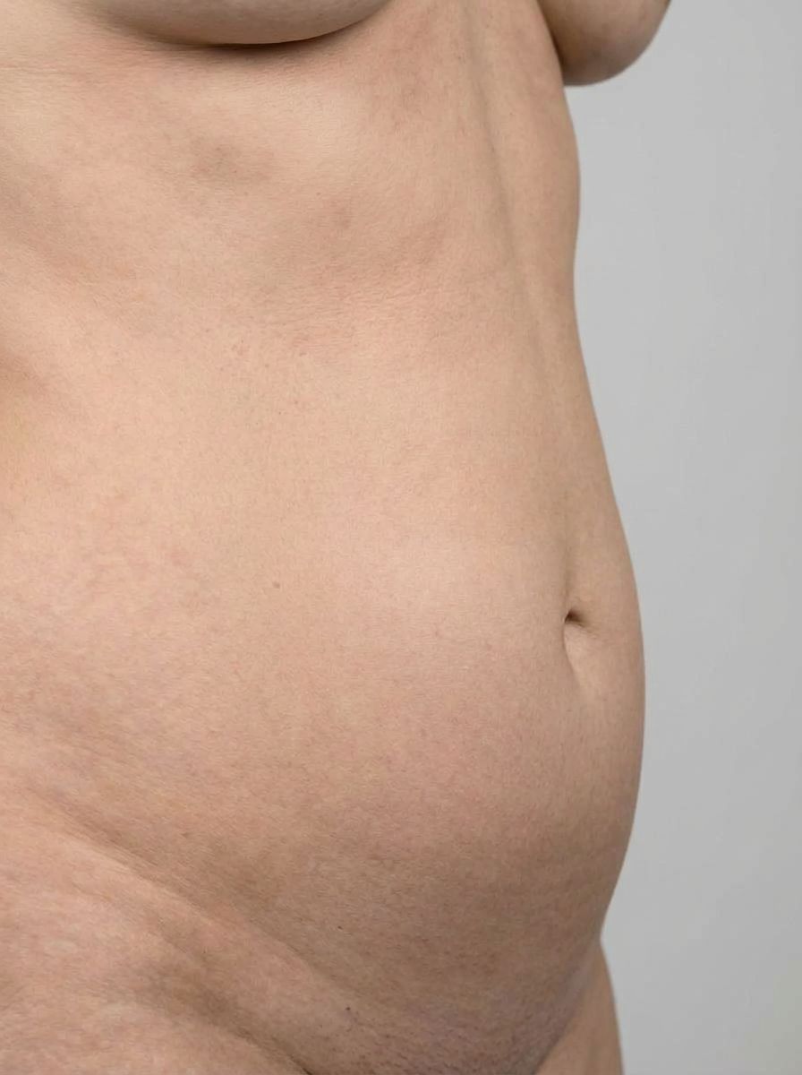 prima e dopo chirurgia bariatrica bendaggio gastrico addome roana bendaggio gastrico per migliorare addome foto dopo - 694