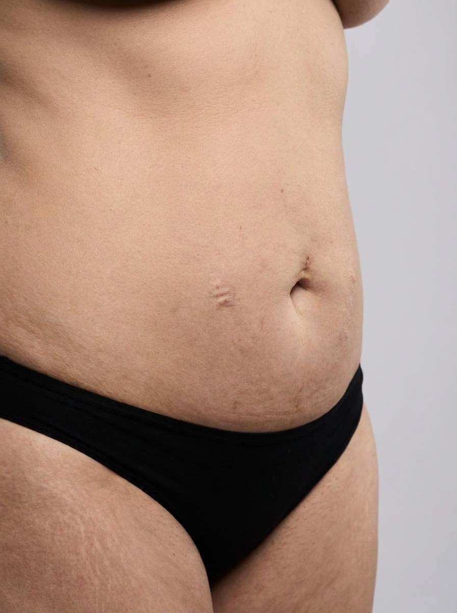 prima e dopo chirurgia bariatrica addome trambileno chirurgia bariatrica per migliorare addome foto dopo - 688