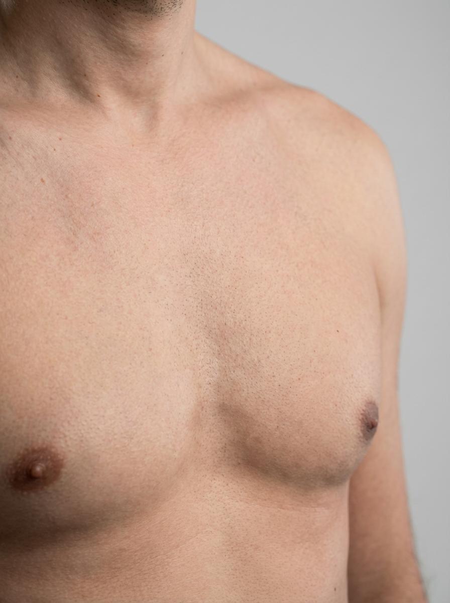 prima e dopo depilazione laser depilazione laser petto petto magrè sulla strada del vino depilazione laser petto per migliorare petto foto dopo - 656