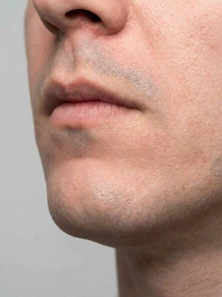 prima e dopo elettrodepilazione elettrodepilazione viso viso san michele all'adige elettrodepilazione viso per migliorare viso foto dopo - 660