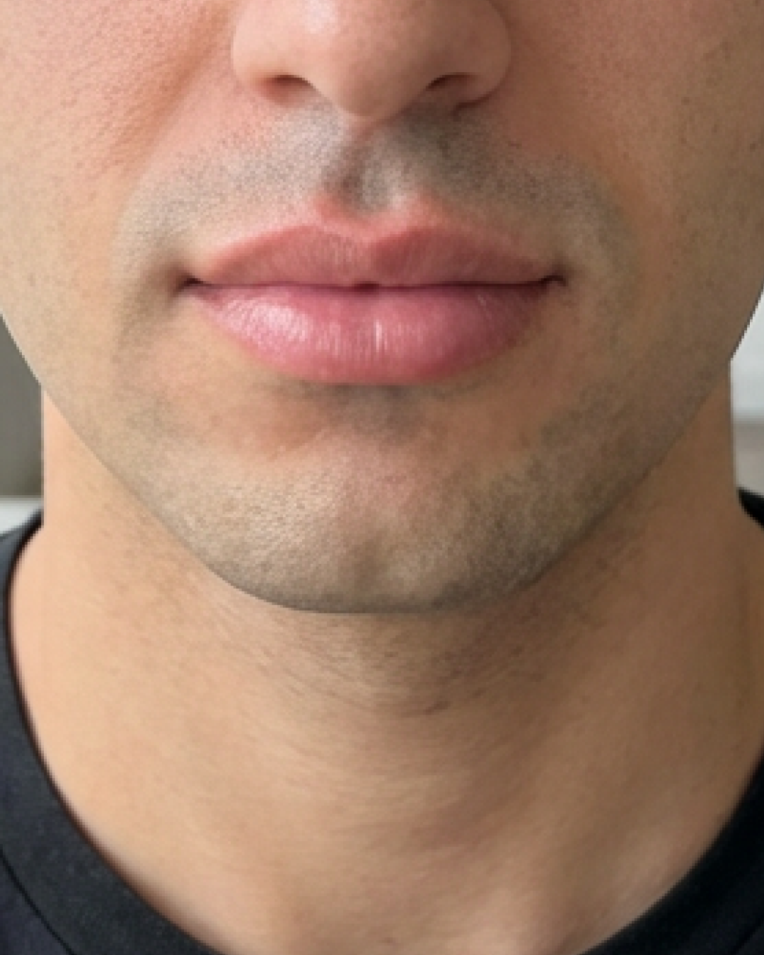 prima e dopo filler filler acido ialuronico labbra uomo roma filler a roma 31-40 anni foto 6 mesi - 696