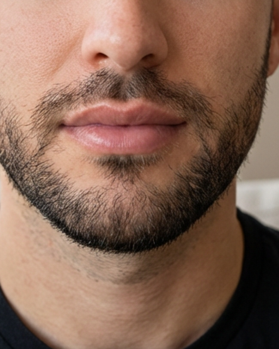 prima e dopo filler labbra uomo trento filler a trento 31-40 anni foto 1 mese - 697