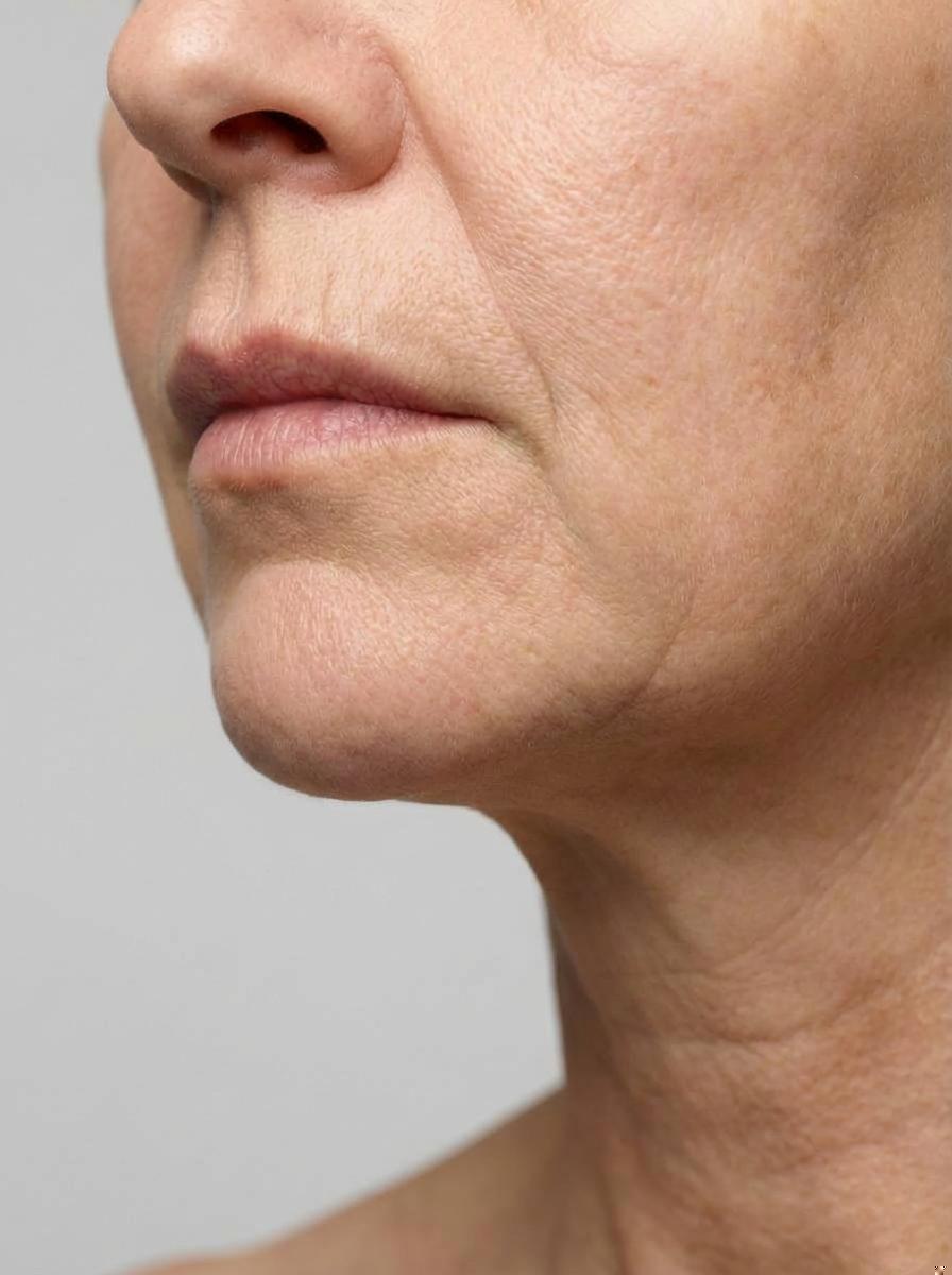 prima e dopo filler filler radiesse mento catanzaro filler radiesse per migliorare mento foto dopo - 53