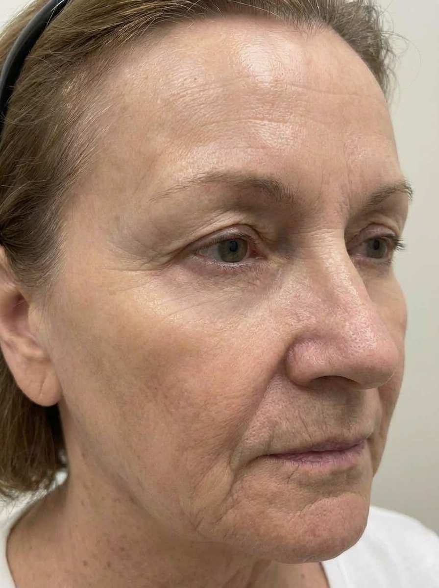 prima e dopo fotoringiovanimento fotoringiovanimento laser viso lona-lases fotoringiovanimento laser per migliorare viso foto dopo - 665