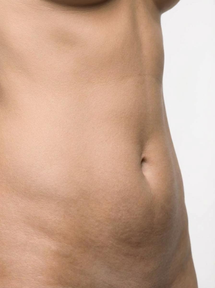 prima e dopo intralipoterapia intralipoterapia adiposità localizzate corpo terrasini intralipoterapia adiposità localizzate per migliorare corpo foto dopo - 529