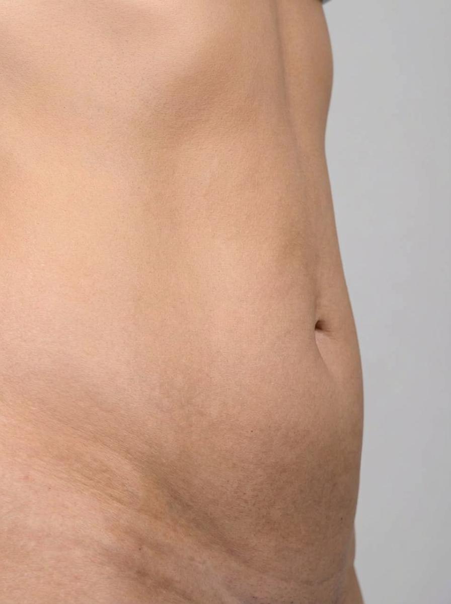prima e dopo laser laserlipolisi corpo cefalù laserlipolisi per migliorare corpo foto dopo - 524