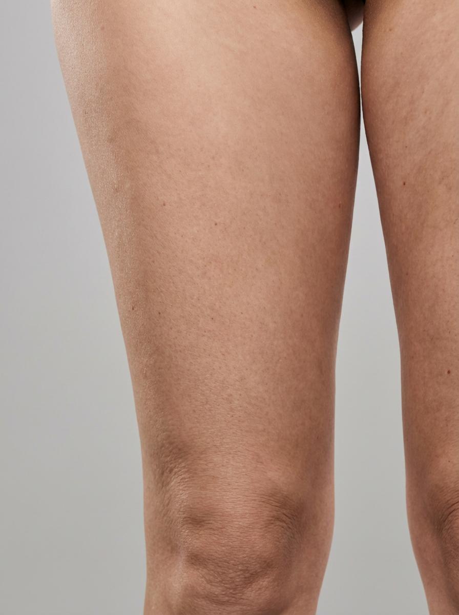 prima e dopo lifting cruroplastica gambe cecina cruroplastica per migliorare gambe foto dopo - 237