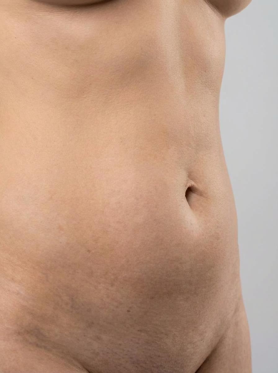 prima e dopo liposuzione liposuzione water jet addome casalpusterlengo liposuzione water jet per migliorare addome foto dopo - 403