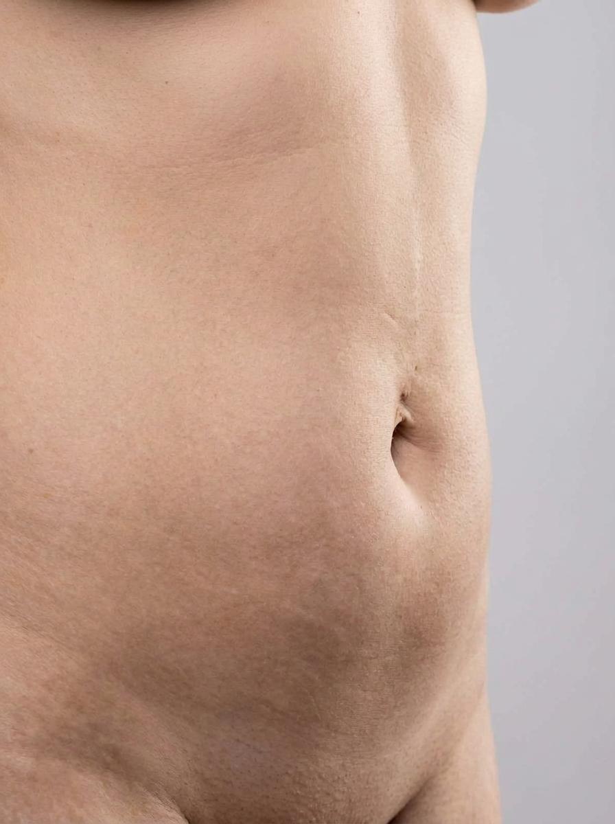 prima e dopo liposuzione liposuzione pal addome gonzaga liposuzione pal per migliorare addome foto dopo - 394