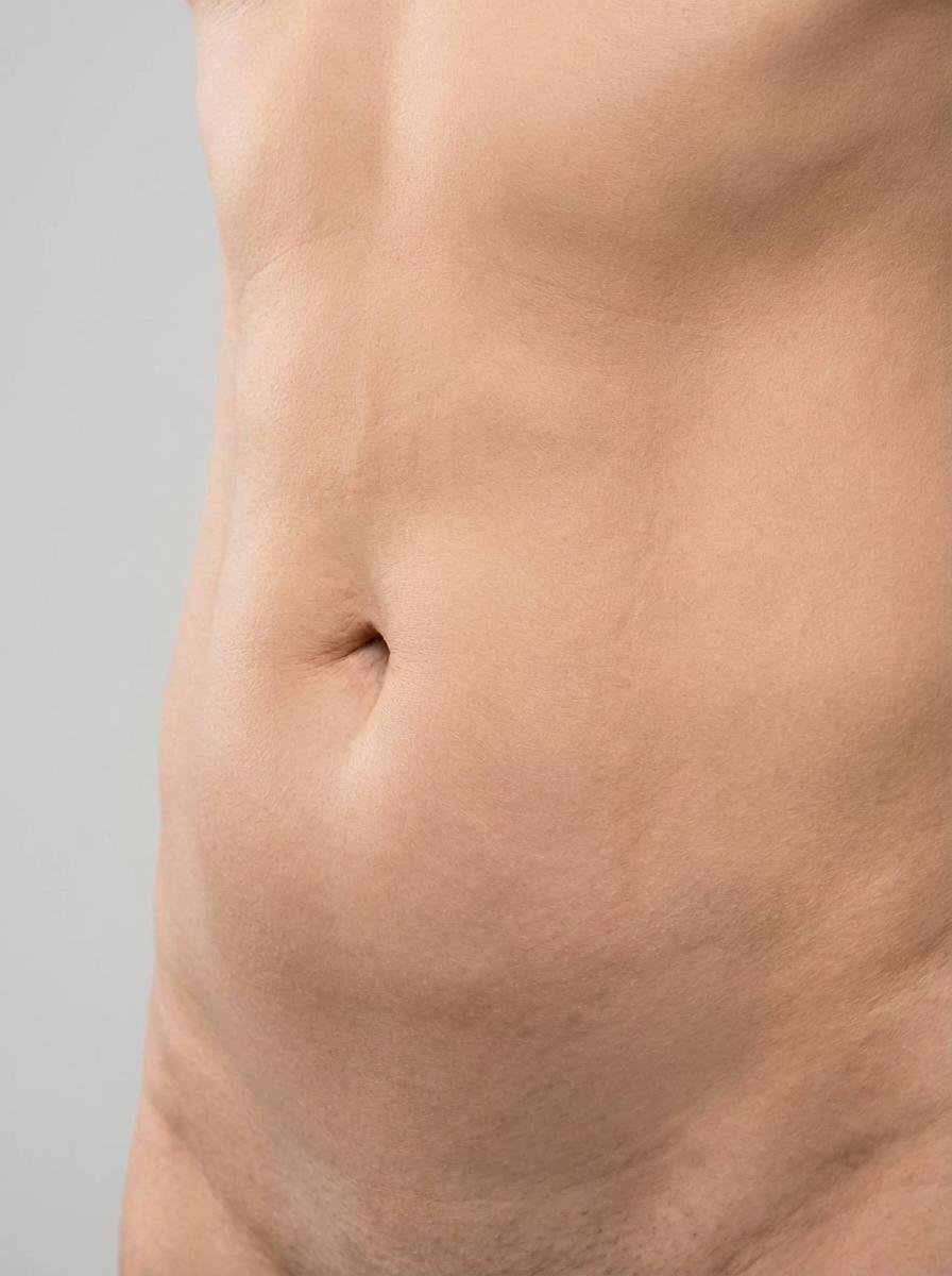 prima e dopo liposuzione liposuzione bodytite addome lumezzane liposuzione bodytite per migliorare addome foto dopo - 412