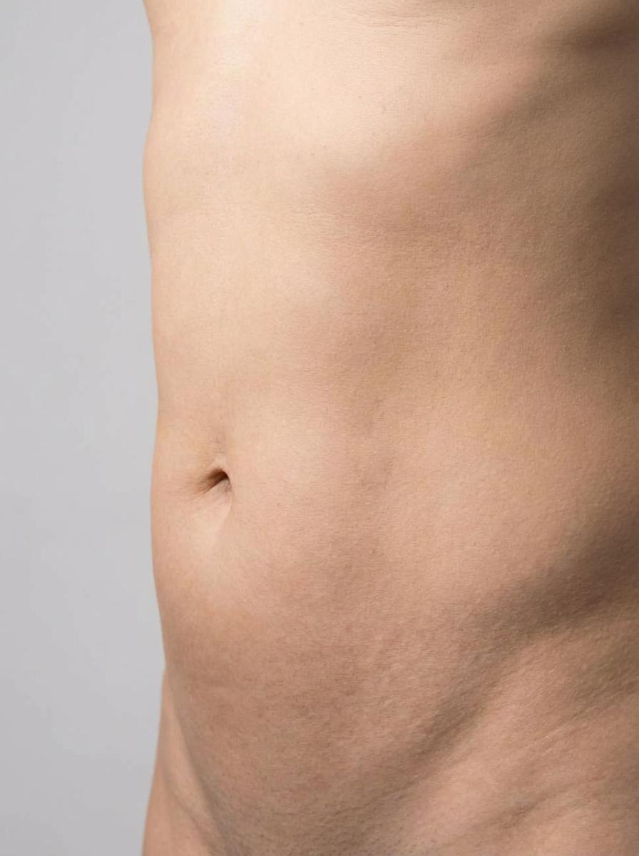 prima e dopo liposuzione liposuzione hd addome montebelluna liposuzione hd per migliorare addome foto dopo - 349