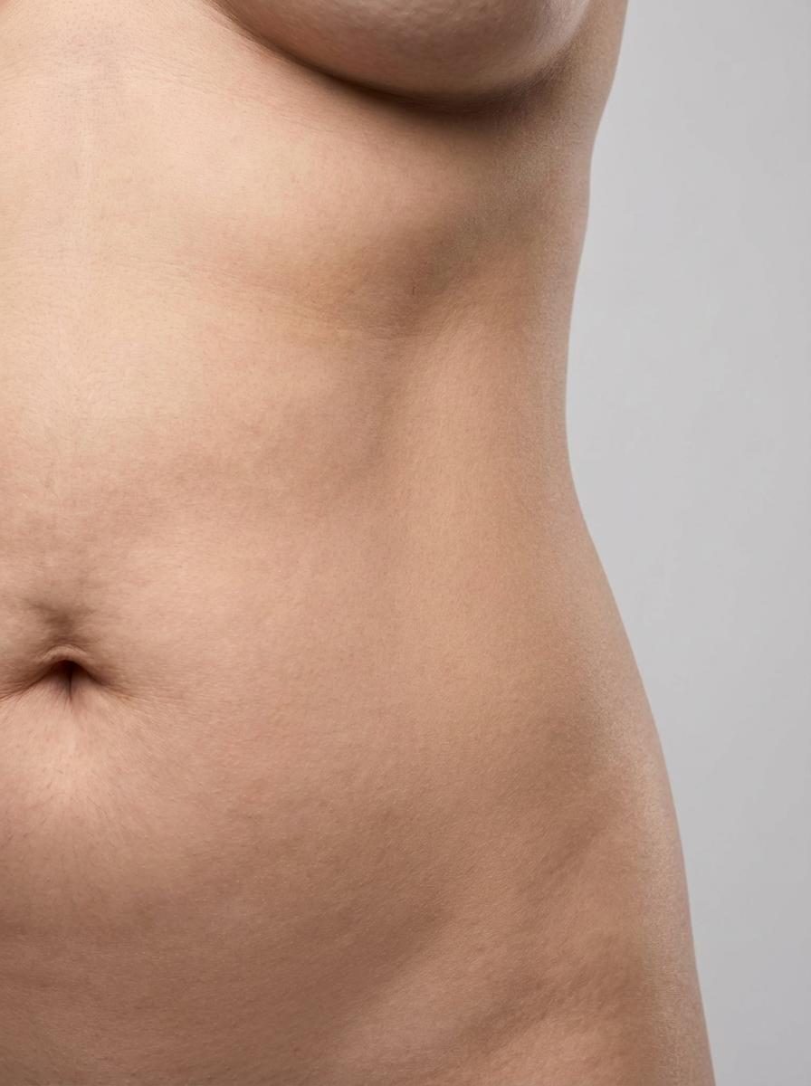 prima e dopo liposuzione liposcultura vaser addome oleggio liposcultura vaser per migliorare addome foto dopo - 432