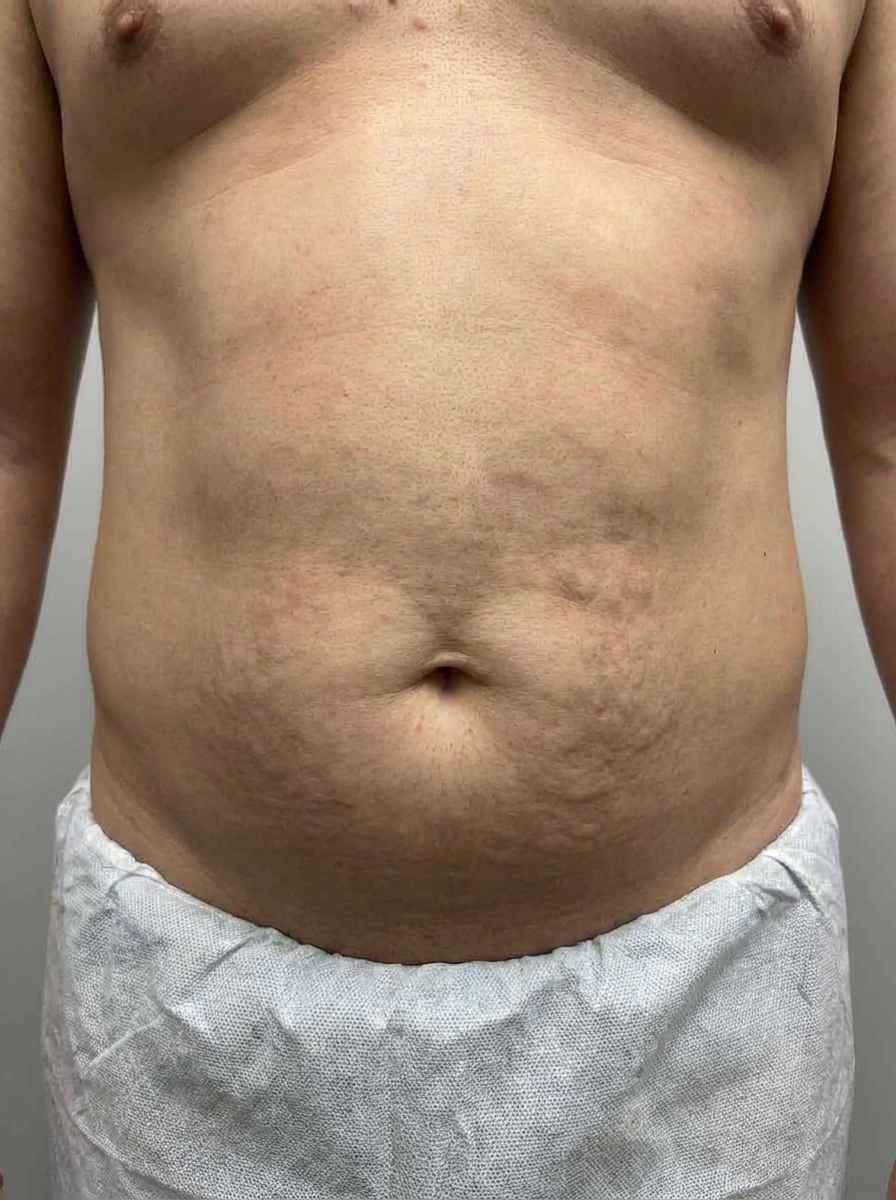 prima e dopo liposuzione liposuzione ultrasonica addome riva del garda liposuzione ultrasonica per migliorare addome foto dopo - 385