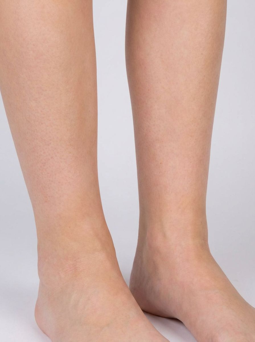 prima e dopo liposuzione liposuzione water jet caviglie montichiari liposuzione water jet per migliorare caviglie foto dopo - 411