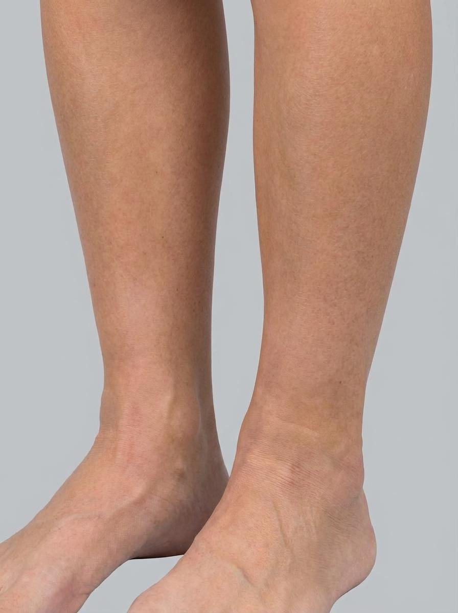 prima e dopo liposuzione liposuzione ultrasonica caviglie viadana liposuzione ultrasonica per migliorare caviglie foto dopo - 393