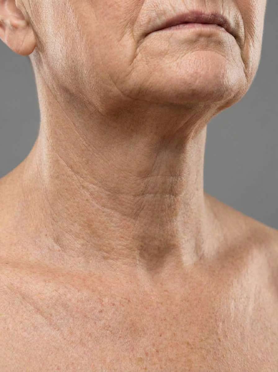 prima e dopo liposuzione liposuzione laser collo spinea liposuzione laser per migliorare collo foto dopo - 344