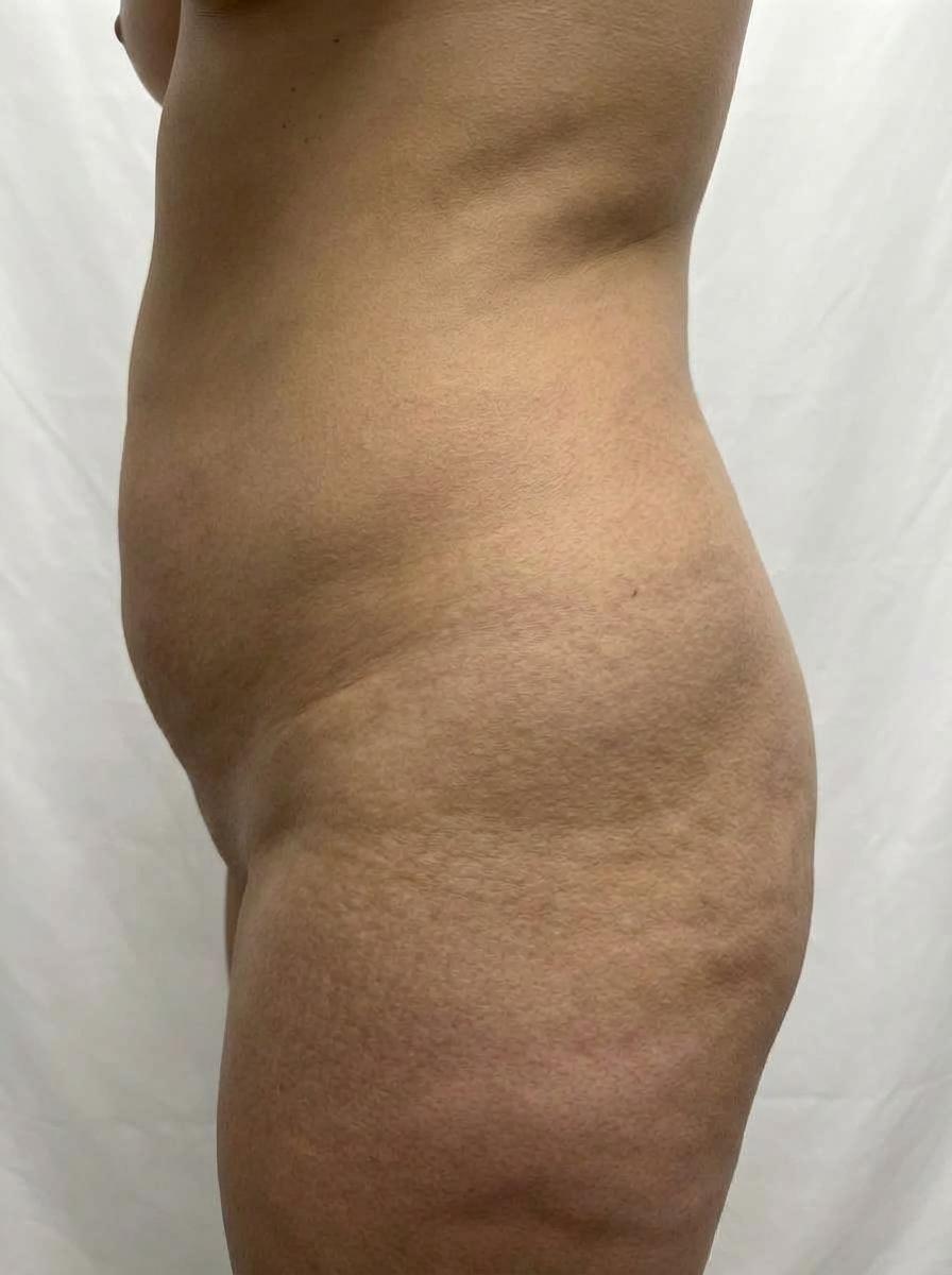 prima e dopo liposuzione liposuzione tumescente fianchi cormons liposuzione tumescente per migliorare fianchi foto dopo - 377