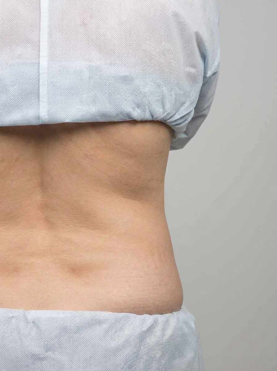 prima e dopo liposuzione liposuzione bodytite fianchi palazzolo sull'oglio liposuzione bodytite per migliorare fianchi foto dopo - 413