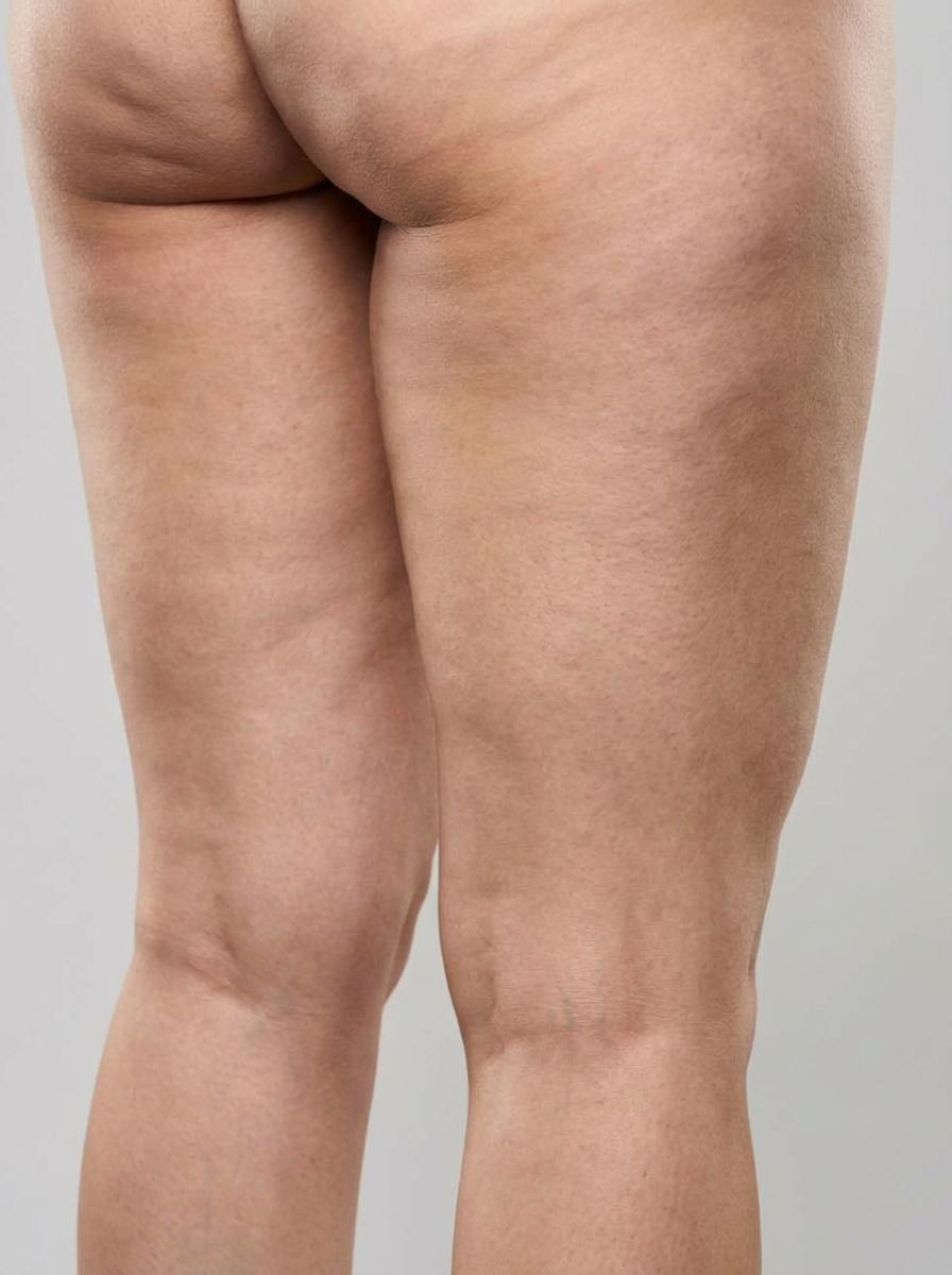 prima e dopo liposuzione liposuzione vaser gambe scorzè liposuzione vaser per migliorare gambe foto dopo - 347