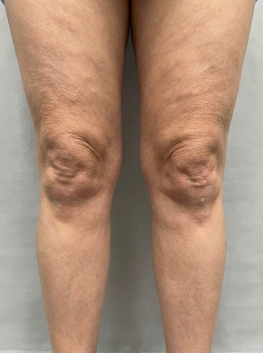 prima e dopo liposuzione liposuzione laser ginocchia san donà di piave liposuzione laser per migliorare ginocchia foto dopo - 341