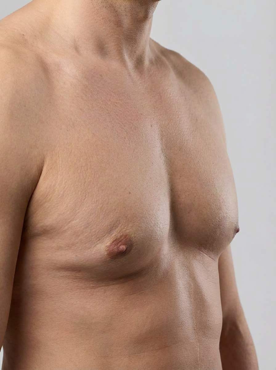 prima e dopo liposuzione liposcultura vaser petto domodossola liposcultura vaser per migliorare petto foto dopo - 433