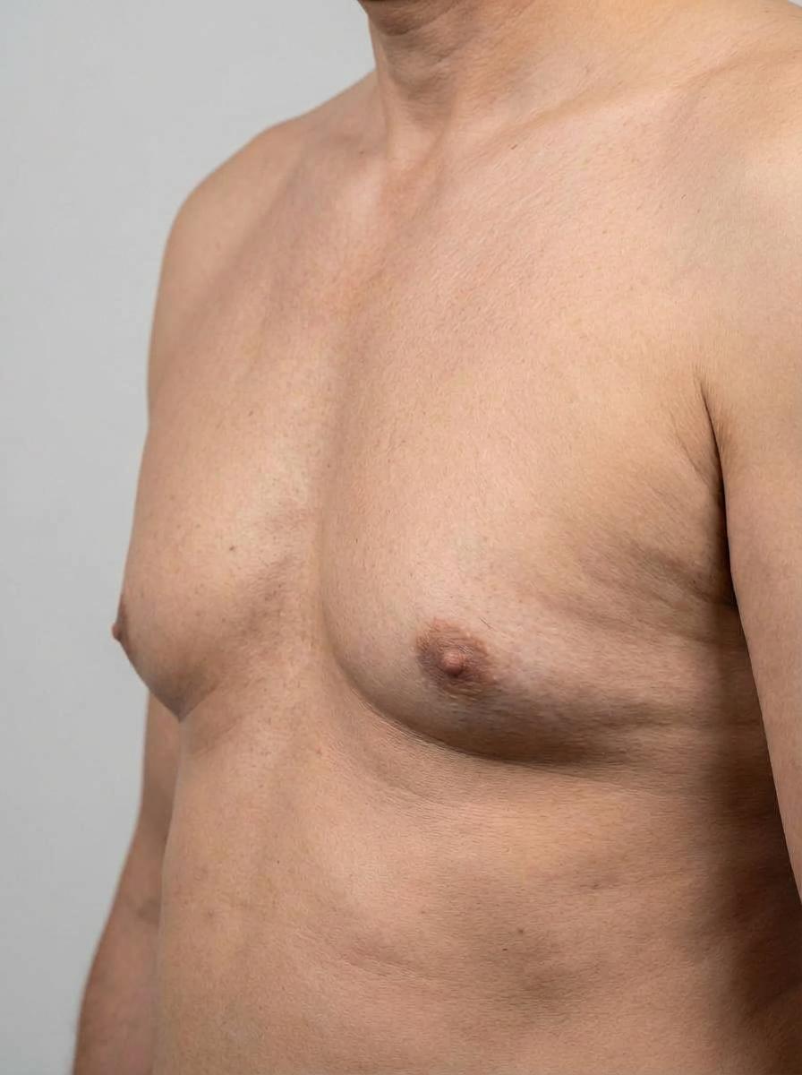 prima e dopo liposuzione petto melfi liposuzione per migliorare petto foto dopo - 332