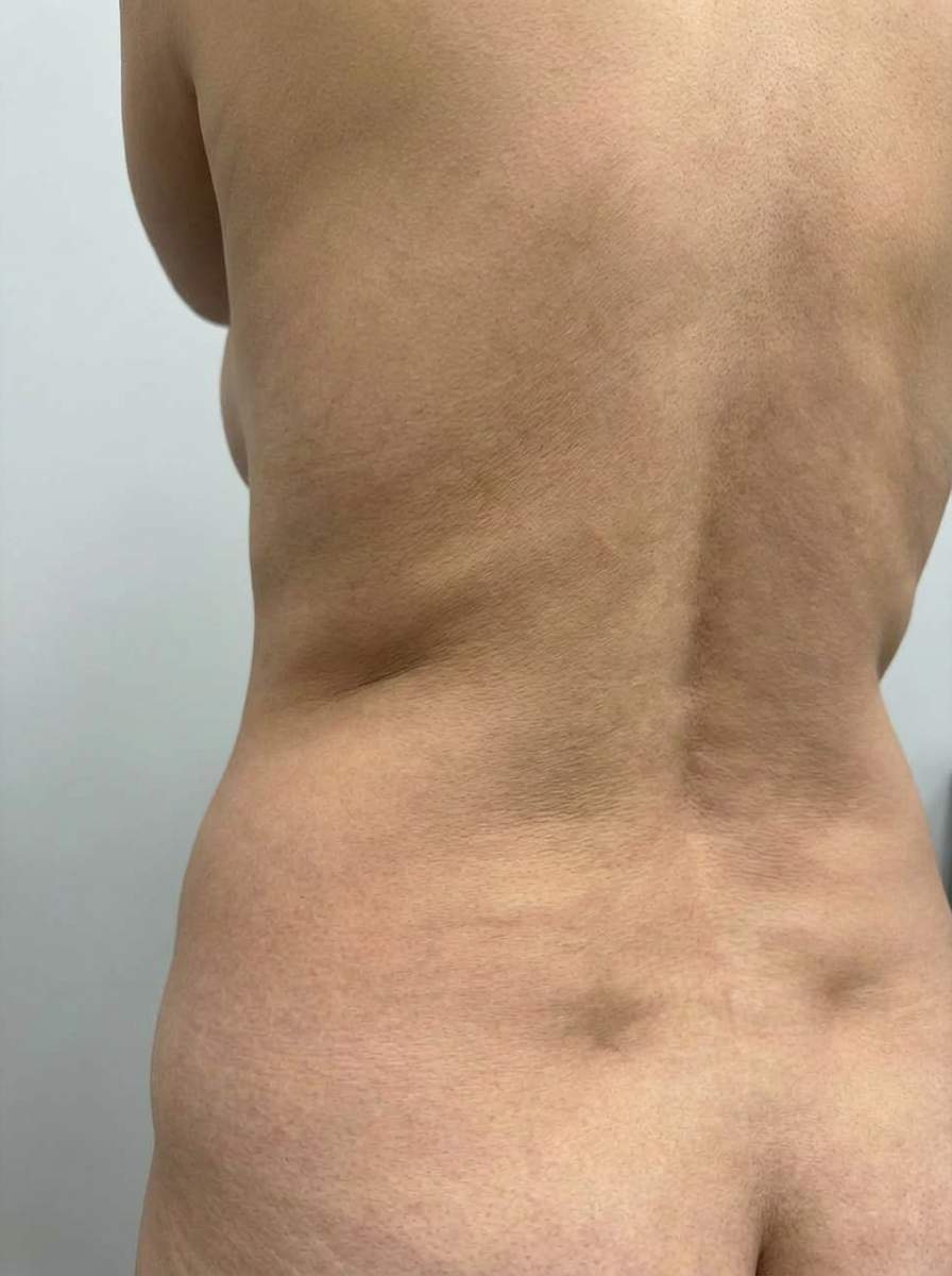 prima e dopo liposuzione schiena san nicola la strada liposuzione per migliorare schiena foto dopo - 326