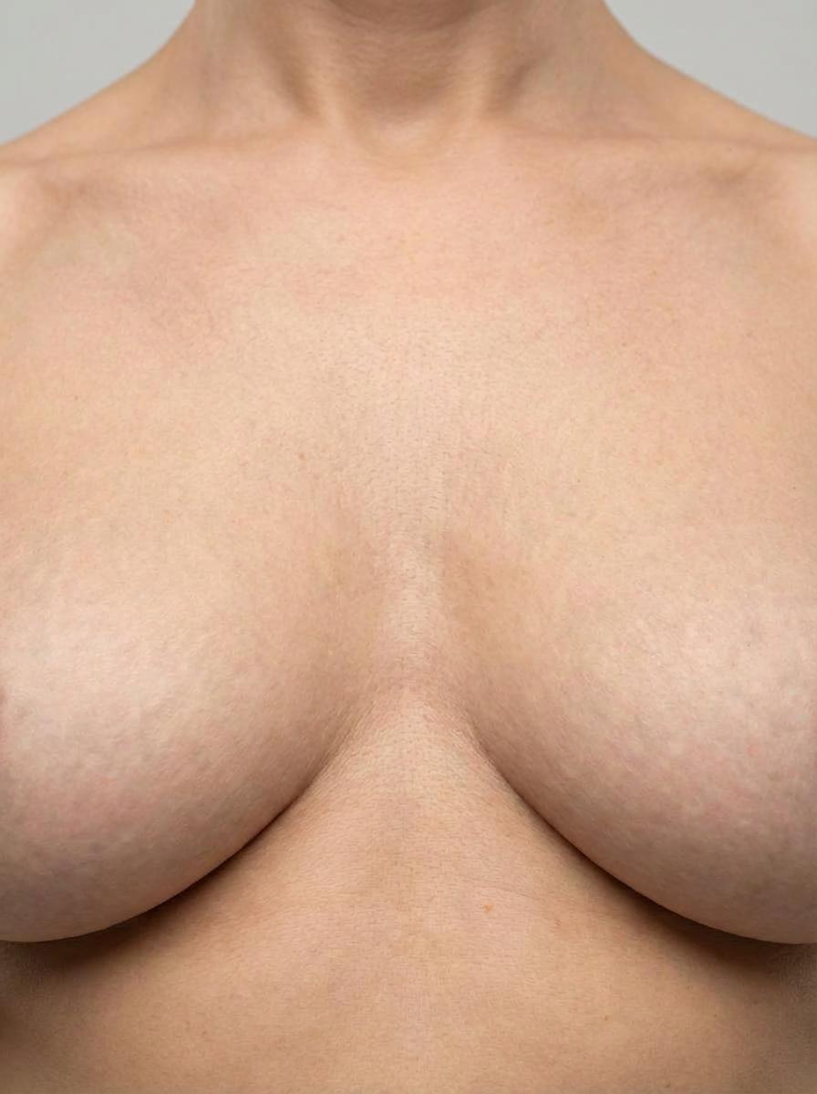 prima e dopo mastoplastica mastoplastica additiva protesi ergonomiche seno elmas mastoplastica additiva protesi ergonomiche per migliorare seno foto dopo - 579