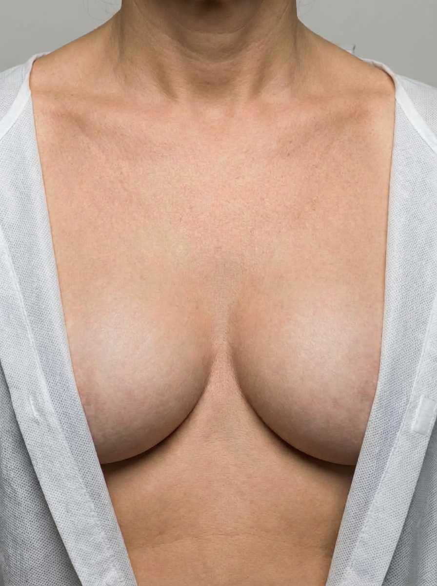 prima e dopo mastoplastica mastoplastica additiva sottofasciale seno selargius mastoplastica additiva sottofasciale per migliorare seno foto dopo - 576