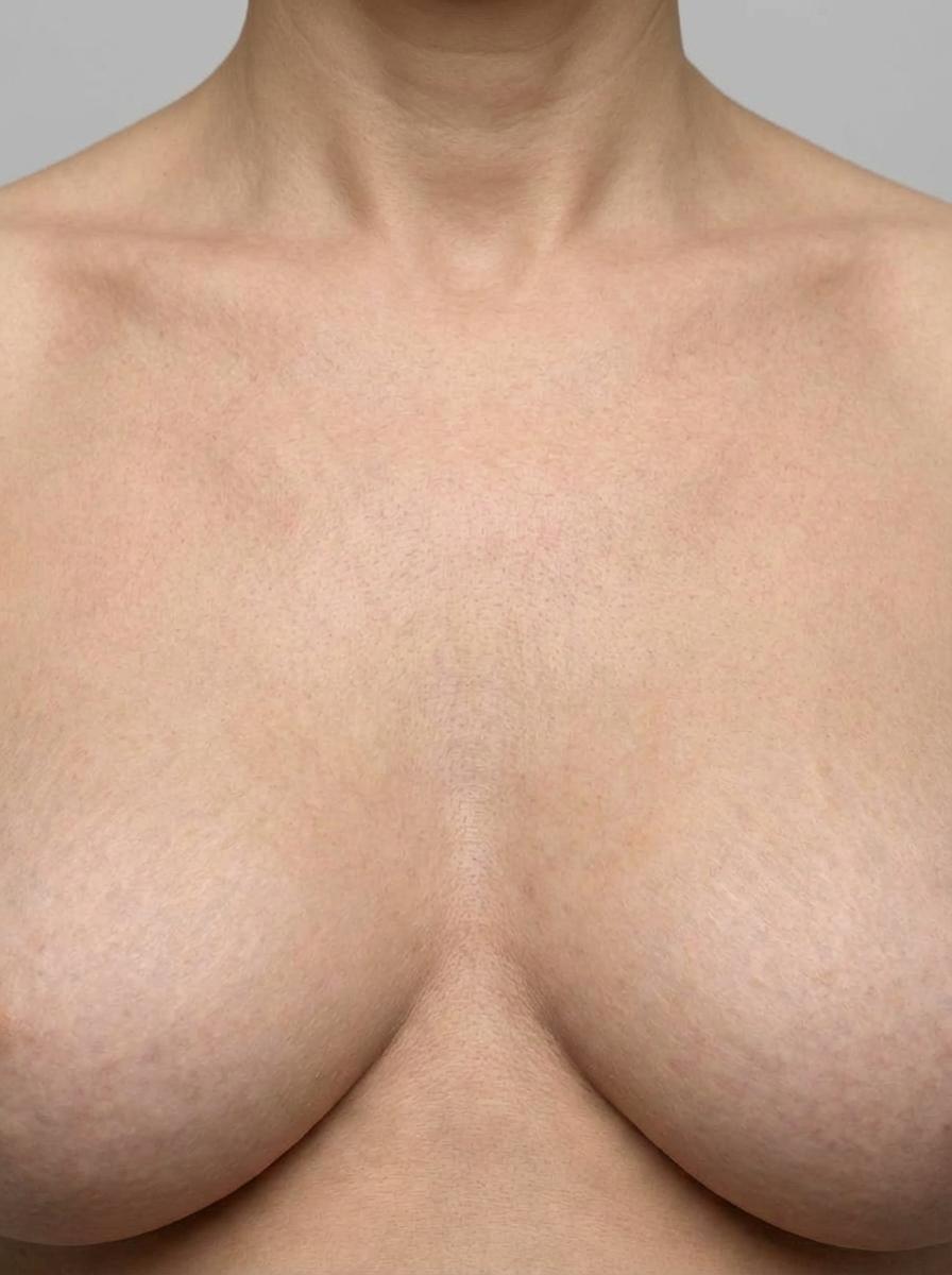 prima e dopo mastoplastica mastoplastica additiva lipofilling seno volvera mastoplastica additiva lipofilling per migliorare seno foto dopo - 572