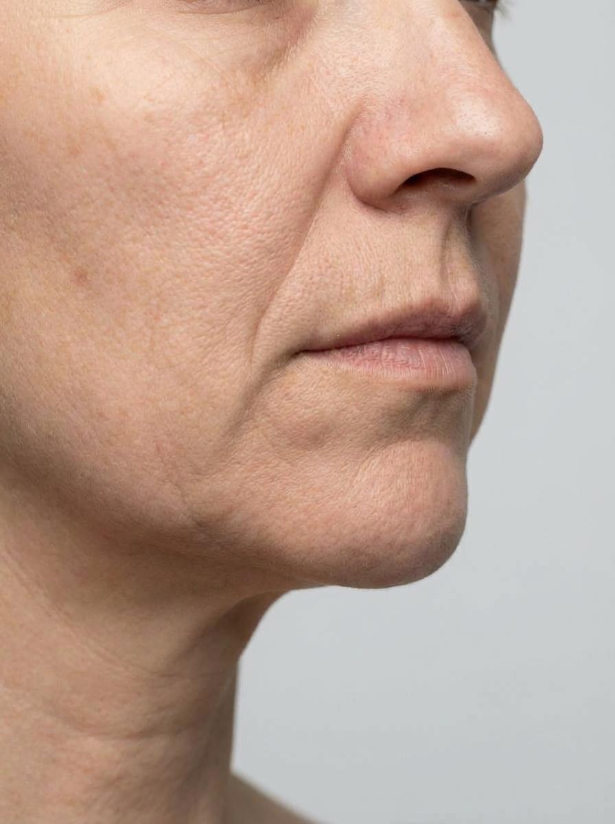 prima e dopo mentoplastica mento camaiore mentoplastica per migliorare mento foto dopo - 245