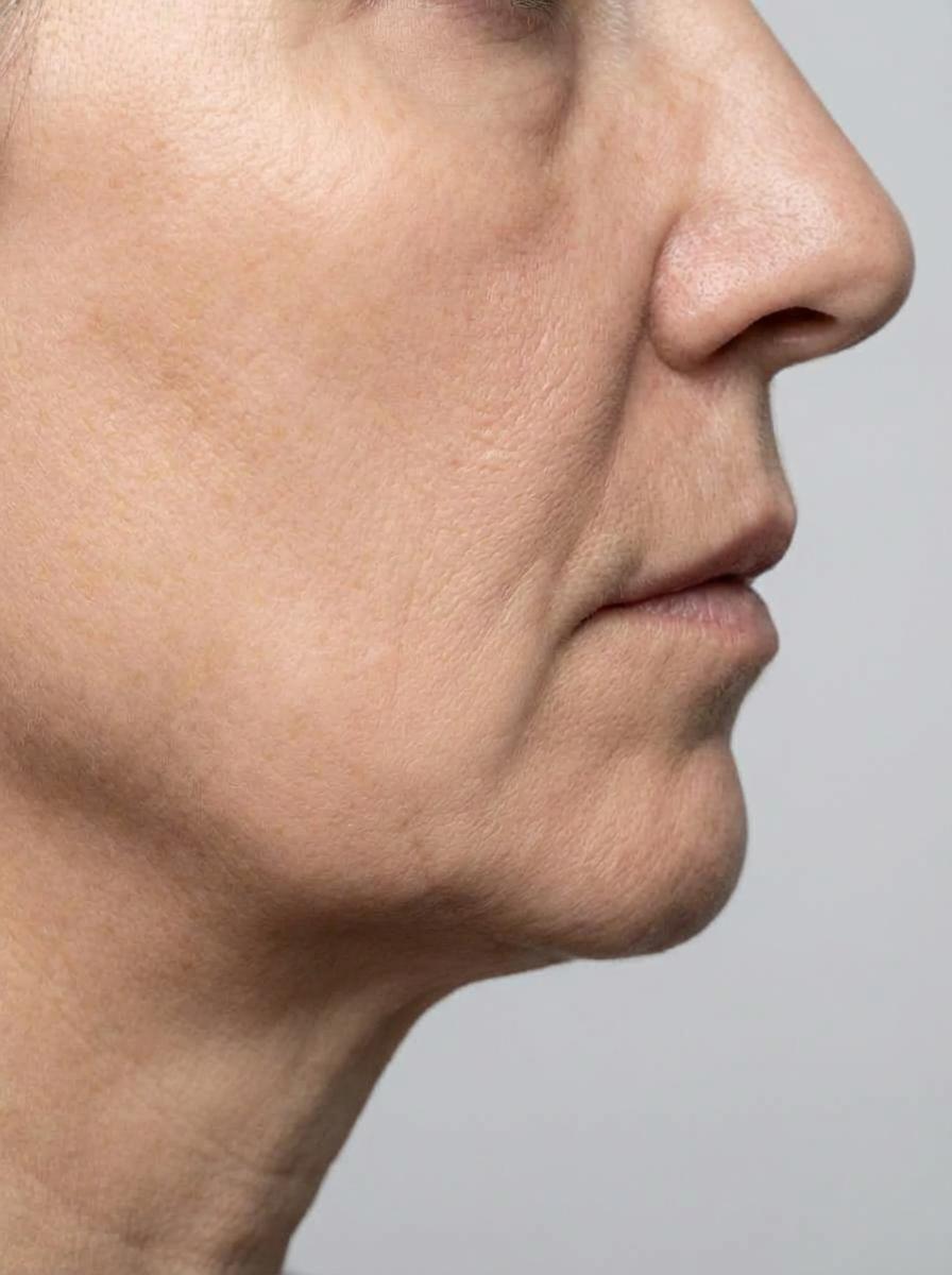 prima e dopo profiloplastica viso montecatini terme profiloplastica per migliorare viso foto dopo - 248