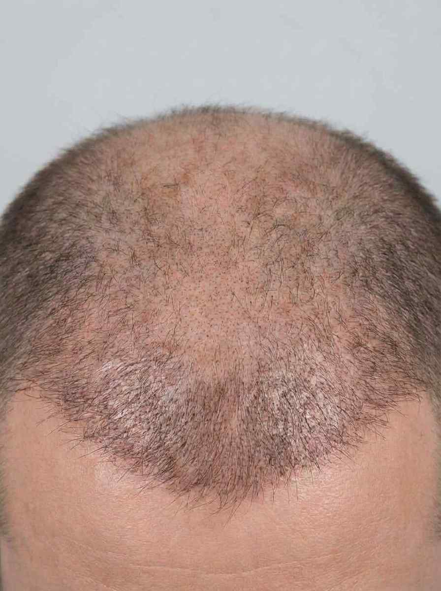 prima e dopo prp capelli capelli sesto prp capelli per migliorare capelli foto dopo - 636