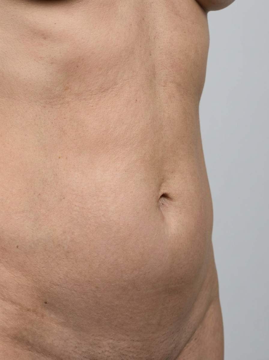 prima e dopo radiofrequenza radiofrequenza morpheus8 corpo diano marina radiofrequenza morpheus8 per migliorare corpo foto dopo - 463