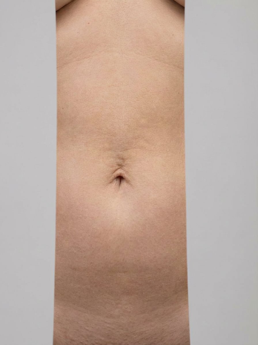 prima e dopo radiofrequenza radiofrequenza venus corpo fidenza radiofrequenza venus per migliorare corpo foto dopo - 467