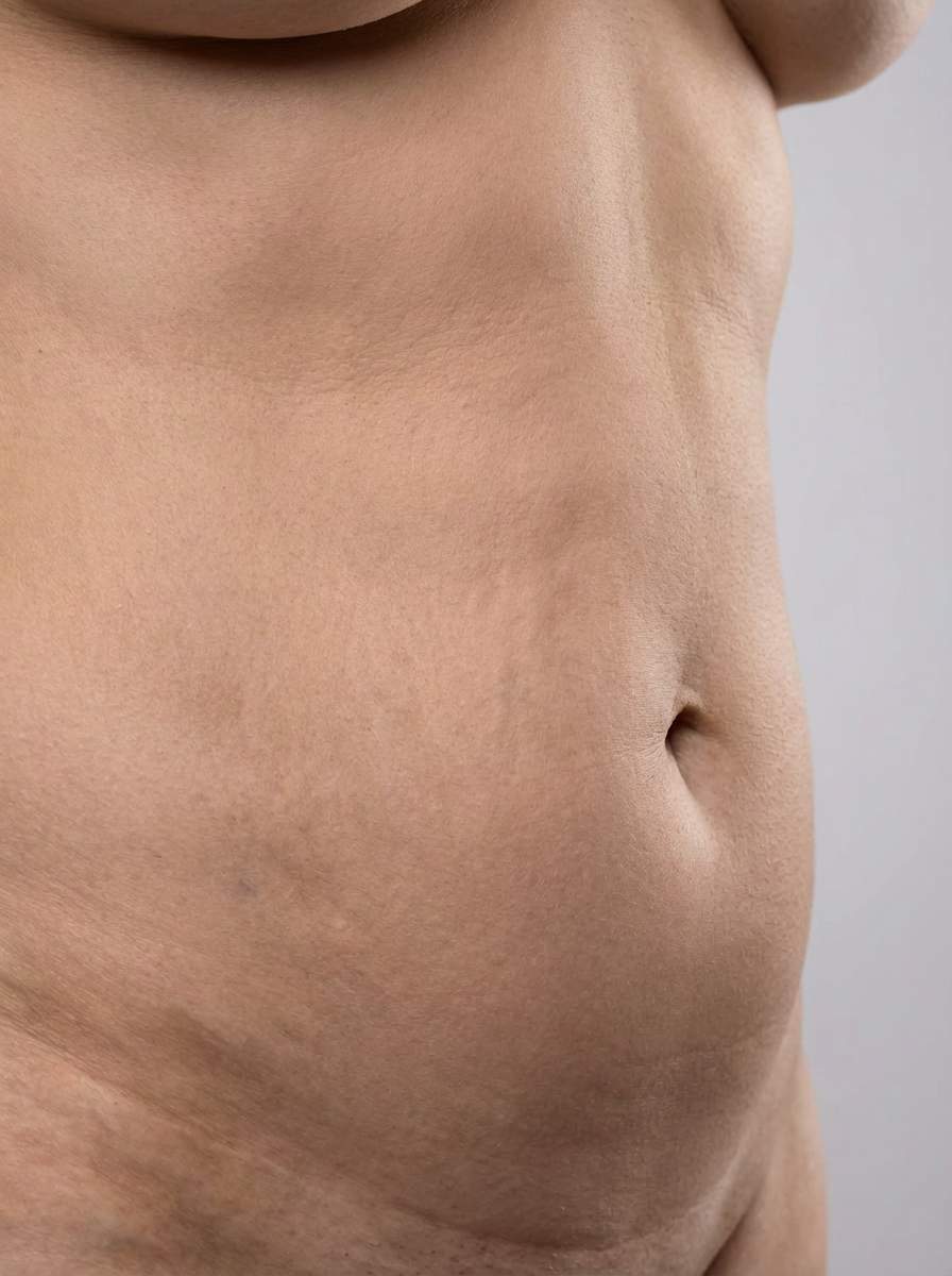prima e dopo radiofrequenza corpo saint-vincent radiofrequenza per migliorare corpo foto dopo - 460