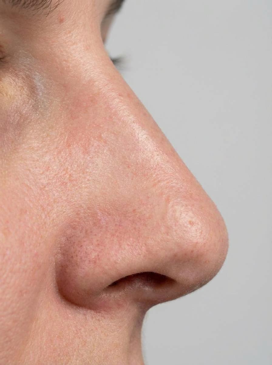 prima e dopo rinoplastica rinoplastica gobba naso cerignola rinoplastica gobba per migliorare naso foto dopo - 188